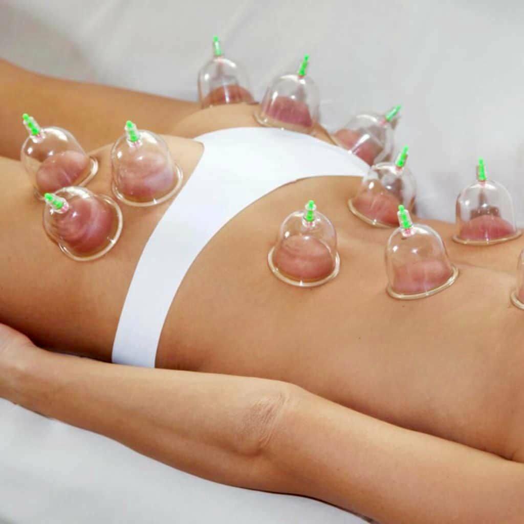 Cupping